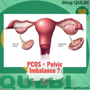 Read more about the article PCOS dan Pelvic Imbalance: Mengurai Hubungan Antara Struktur dan Fungsi