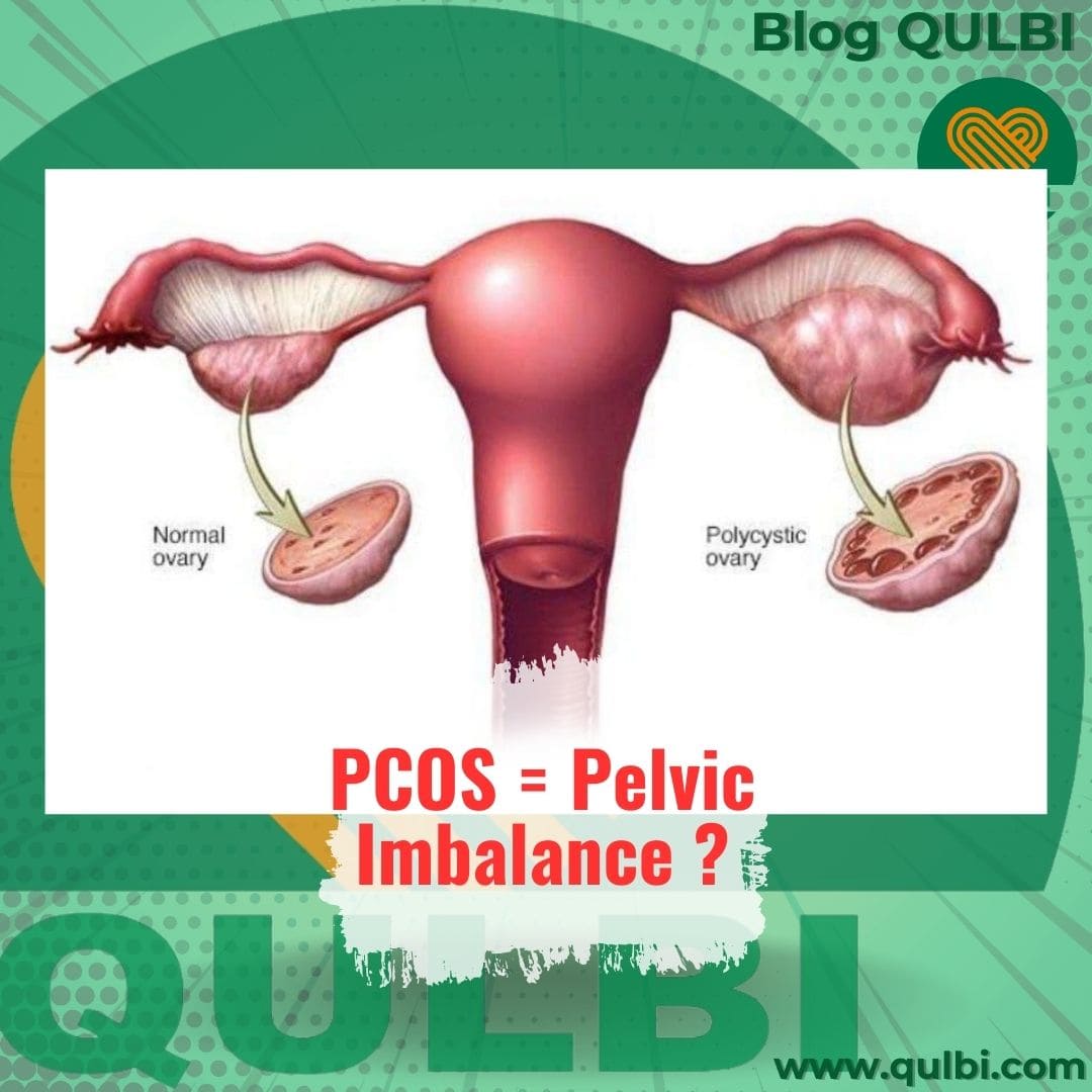 You are currently viewing PCOS dan Pelvic Imbalance: Mengurai Hubungan Antara Struktur dan Fungsi