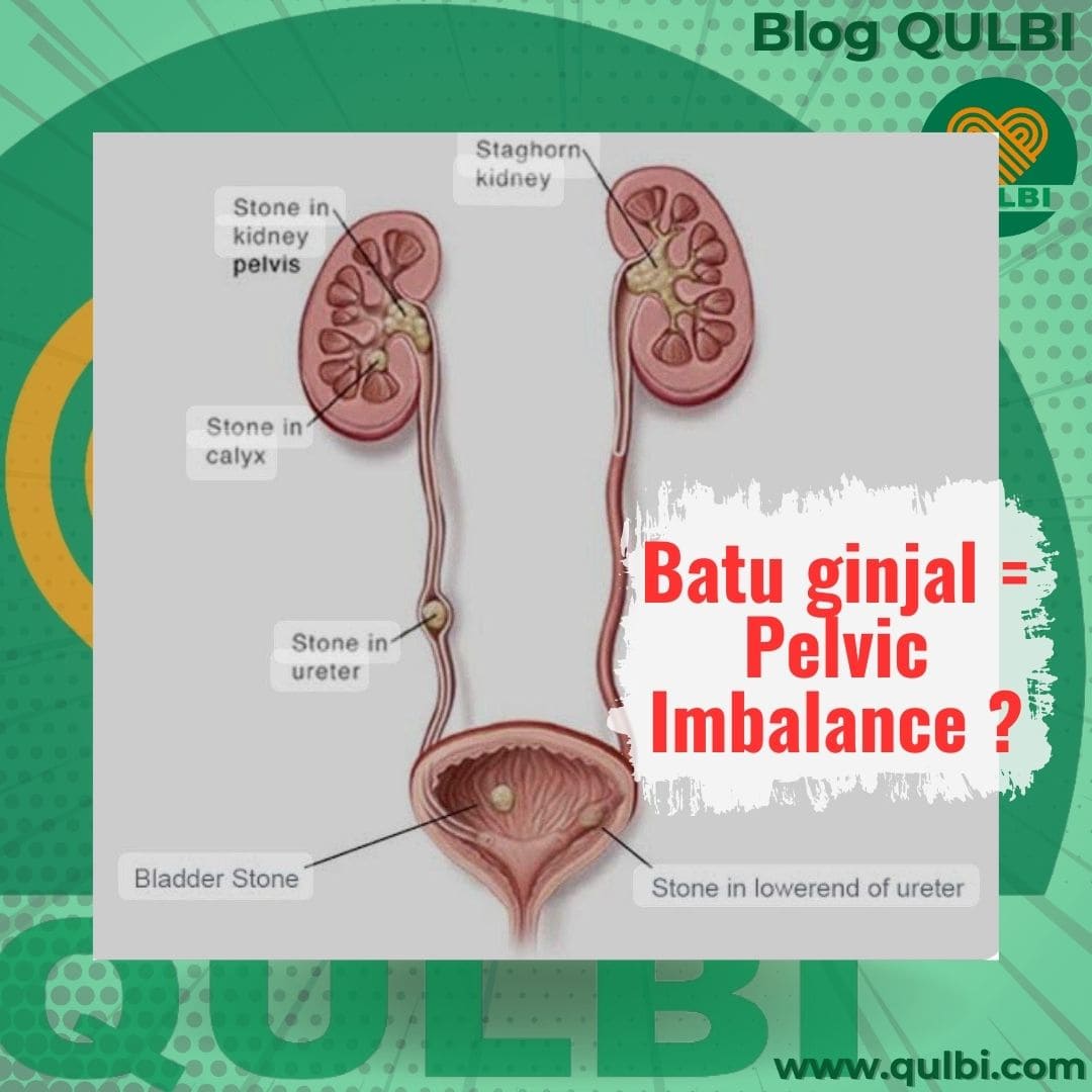 Read more about the article Nyeri Batu Ginjal dan Imbalance Pelvis: Mengapa Kedua Masalah Ini Bisa Saling Terkait?