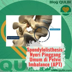 Read more about the article Waspada Spondylolisthesis: Sakit Pinggang Saat Tulang Belakang Geser Diam-Diam & Solusinya ala FASCIA Hack