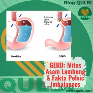Read more about the article GERD Bukan Karena Asam Lambung Berlebih, Tapi Karena Kurang! Dan Bisa Jadi Karena Posisi Pelvis Miring!