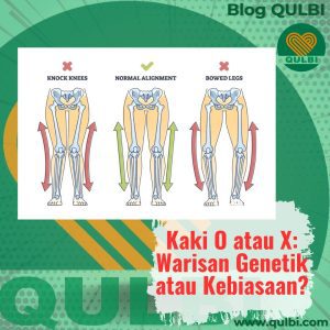Read more about the article Bongkar Biomekanika Kaki O & X: Bukan Turunan, Tapi Efek Domino dari Panggul Sampai Telapak!