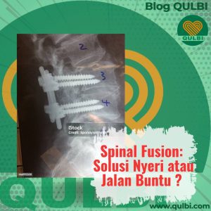 Read more about the article Fusi Tulang Belakang: Solusi Nyeri atau Jalan Buntu? Yuk Kenalan Sama FASCIA Hack Sebelum Terlambat!