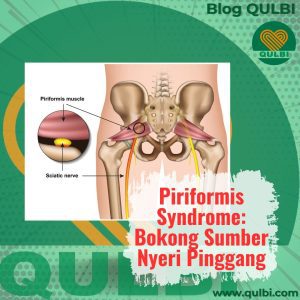 Read more about the article Piriformis Syndrome: Ketika Bokong Jadi Biang Kerok Sakit Pinggang & FASCIA Hack Solusinya