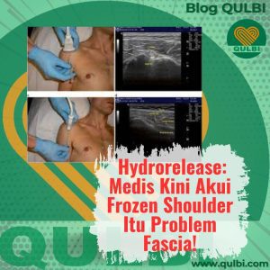 Read more about the article Hydrorelease: Medis Kini Akui Frozen Shoulder Bukan Hanya Radang, Tapi Problem Fascia