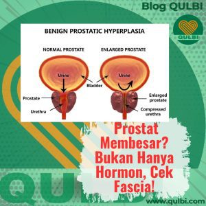 Read more about the article Prostat Membesar (BPH): Jangan Hanya Fokus ke Hormon, Cek Juga Fascia-mu!