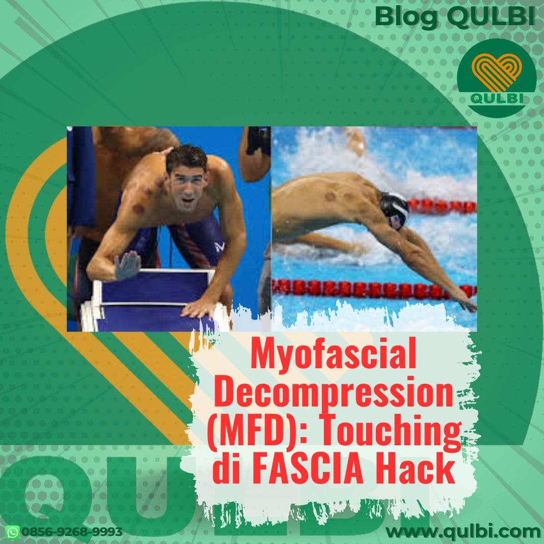 Read more about the article Myofascial Decompression (MFD): Cupping Dinamis Modalitas Touching dI FASCIA Hack